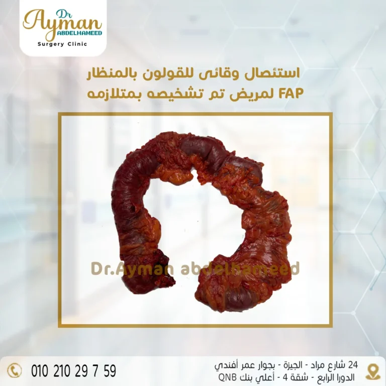Read more about the article استئصال وقائى للقولون بالمنظار