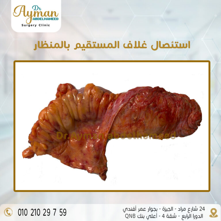 Read more about the article نجاح عملية استئصال غلاف المستقيم بالمنظار