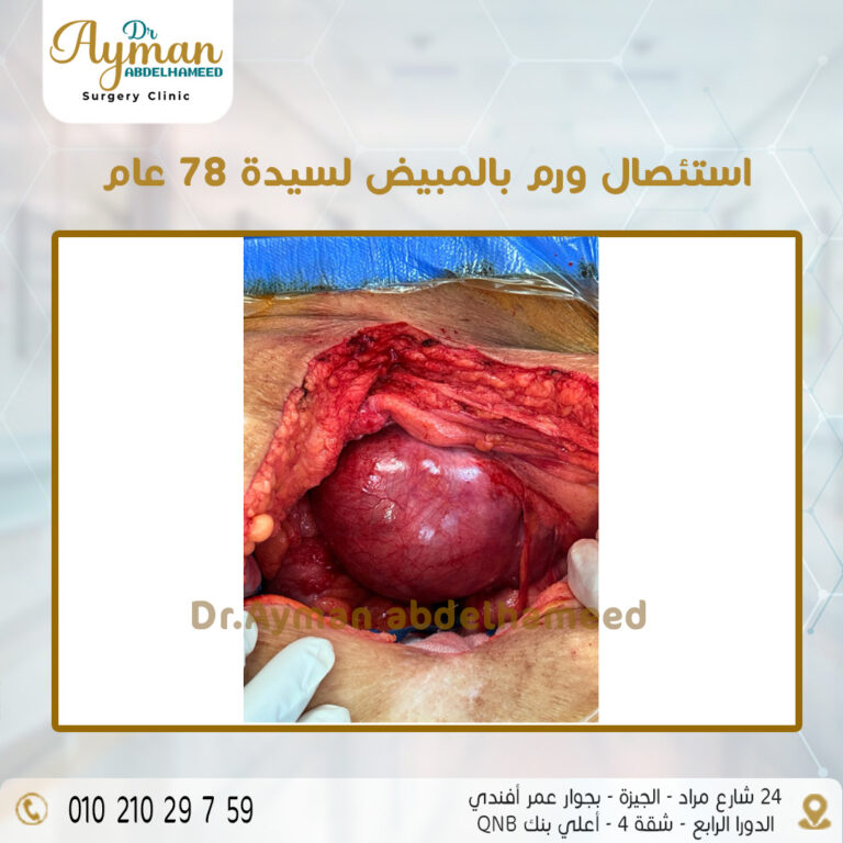 Read more about the article استئصال ورم بالمبيض لسيدة 78 عام
