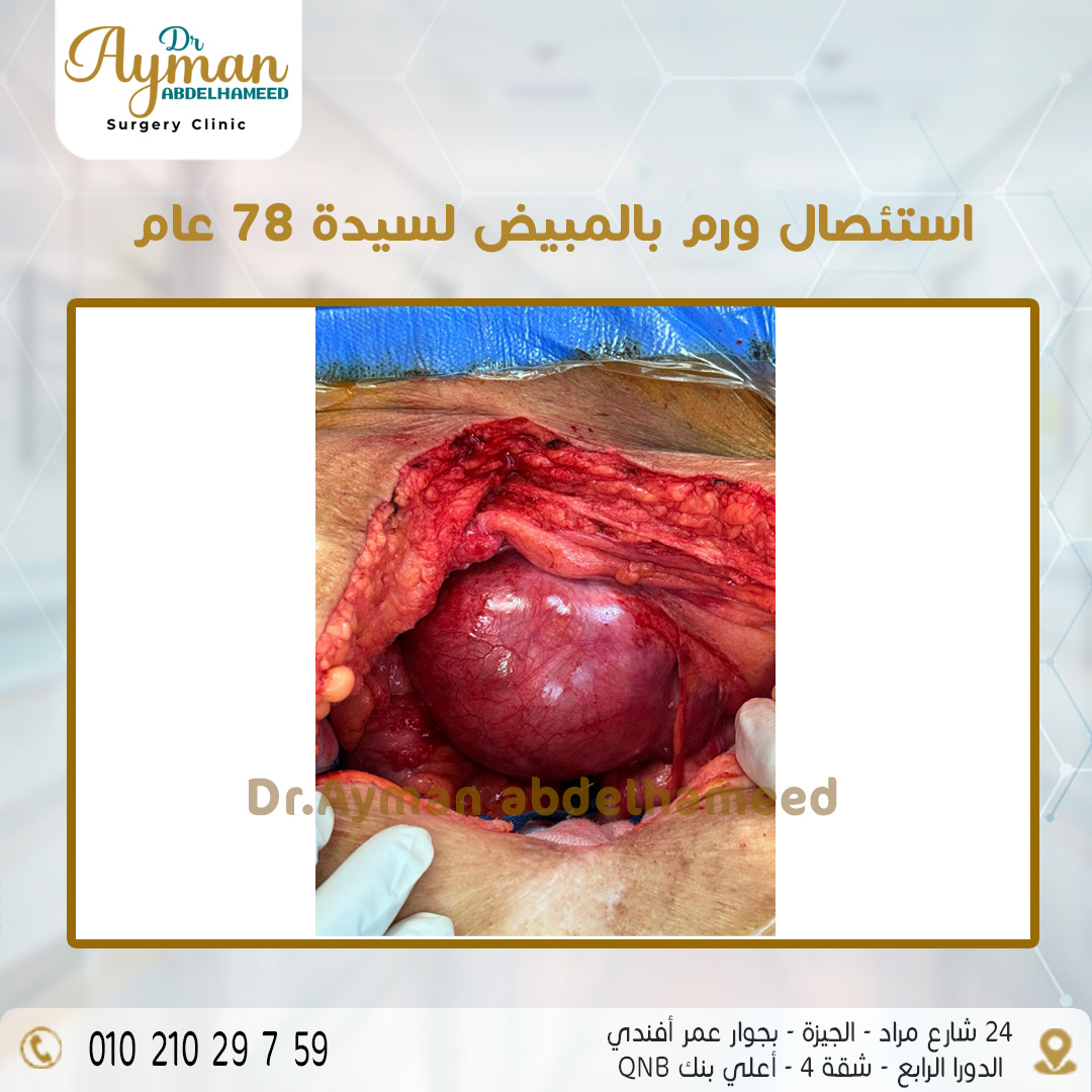 You are currently viewing استئصال ورم بالمبيض لسيدة 78 عام