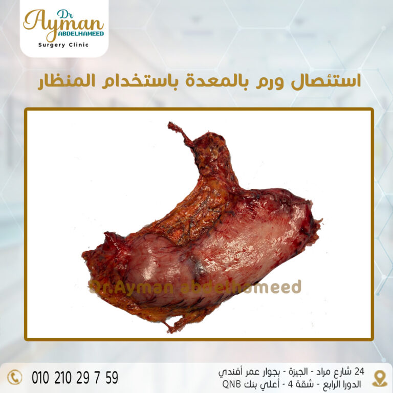 Read more about the article نجاح استئصال ورم بالمعدة باستخدام المنظار