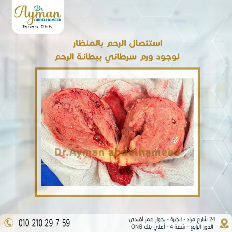 Read more about the article نجاح عملية استئصال الرحم بالمنظار