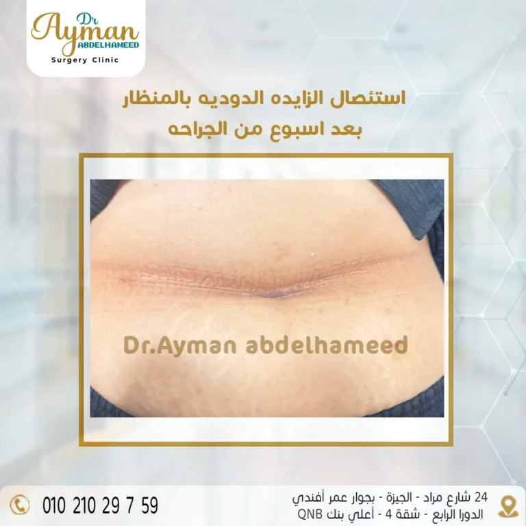 Read more about the article استئصال الزائدة الدودية بالمنظار