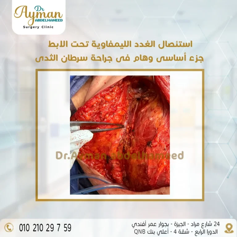 Read more about the article استئصال الغدد الليمفاوية تحت الابط