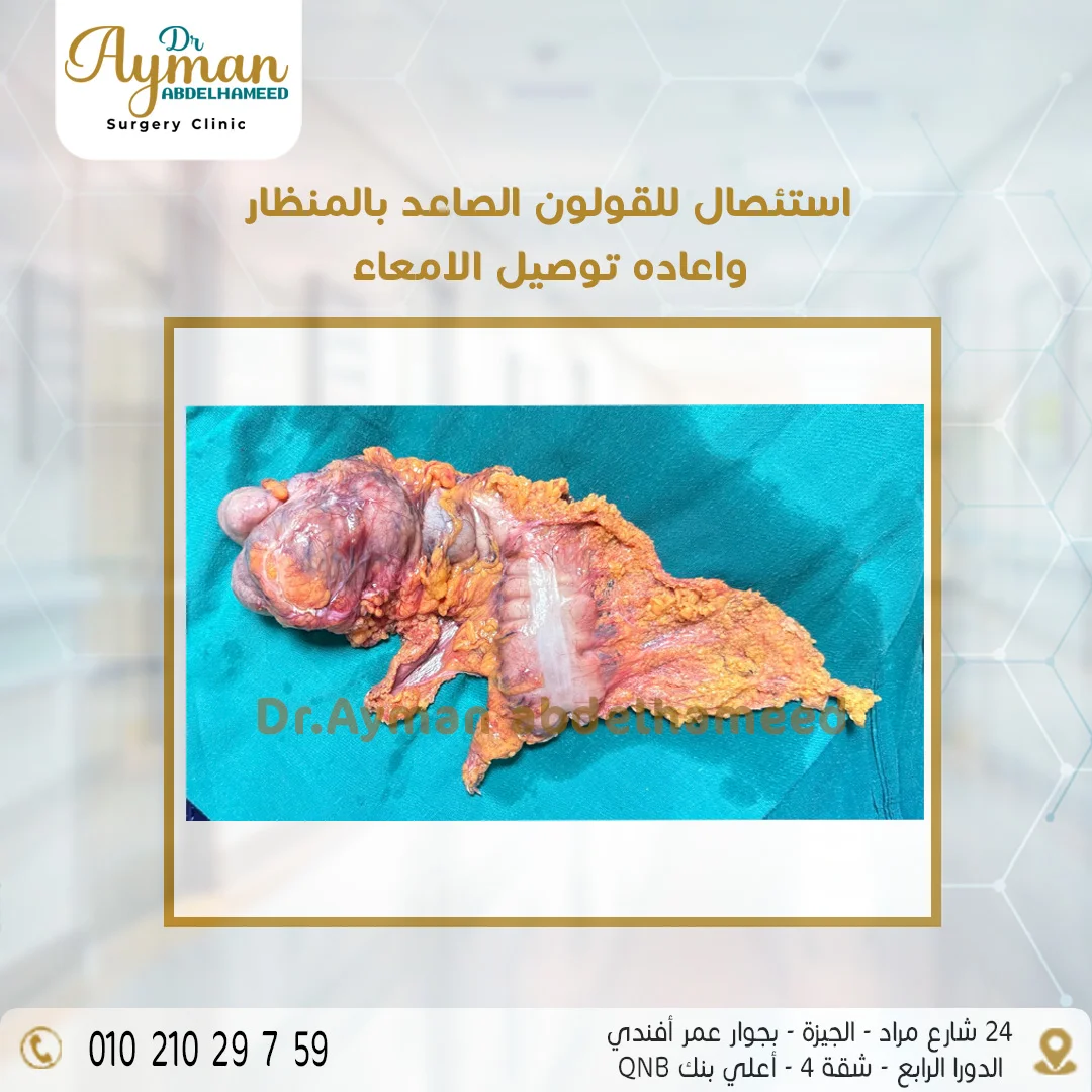 You are currently viewing استئصال القولون الصاعد بالمنظار وإعادة توصيل الأمعاء
