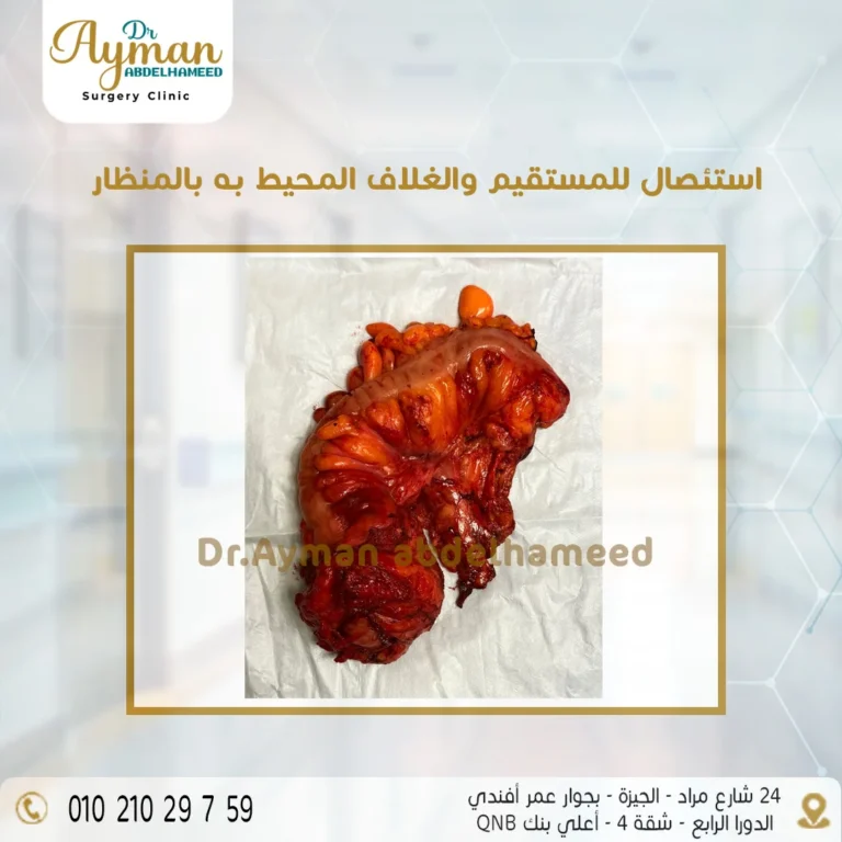 Read more about the article استئصال المستقيم والغلاف المحيط به بالمنظار