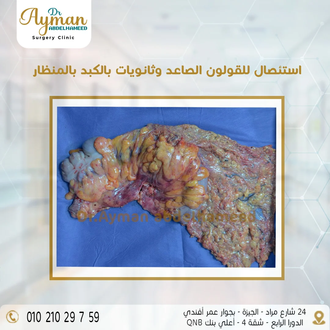 Read more about the article استئصال للقولون الصاعد وثانويات بالكبد بالمنظار