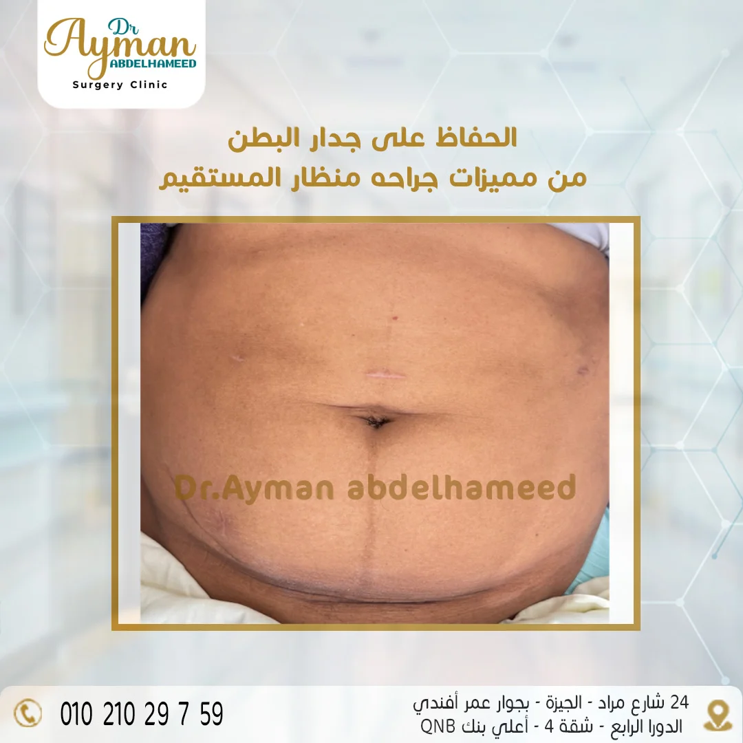 You are currently viewing الحفاظ على جدار البطن من مميزات جراحة منظار المستقيم
