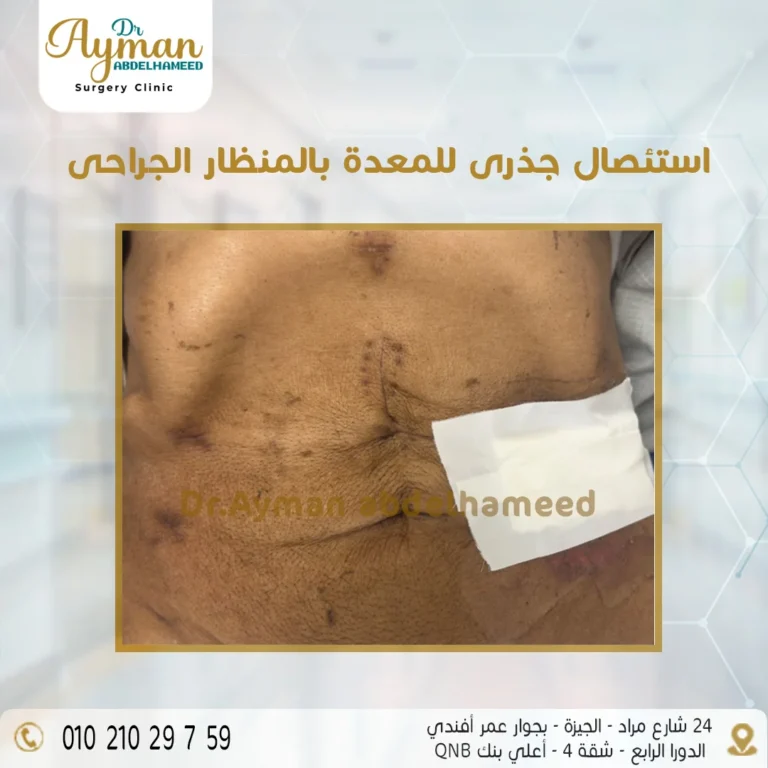 Read more about the article استئصال جذرى للمعدة بالمنظار الجراحى