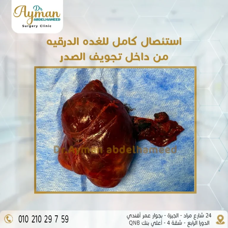Read more about the article استئصال كامل للغدة الدرقية من داخل تجويف الصدر