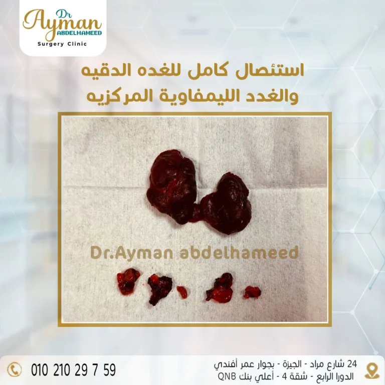 Read more about the article استئصال كامل للغدة الدرقية والغدد الليمفاوية المركزية