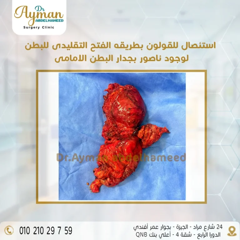 Read more about the article علاج سرطان القولون المصاحب لناسور جدار البطن