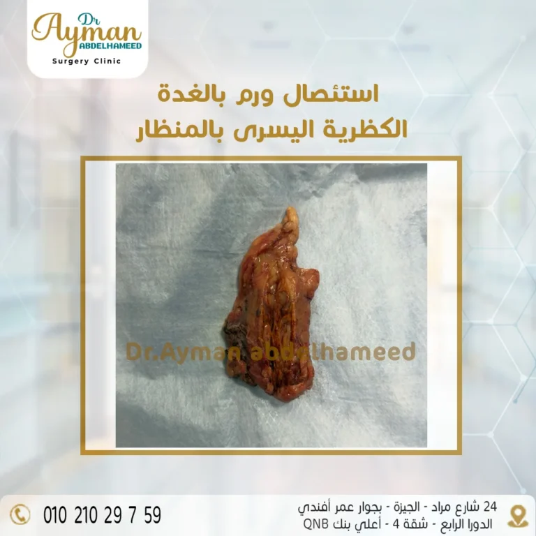 Read more about the article استئصال ورم بالغدة الكظرية اليسرى بالمنظار