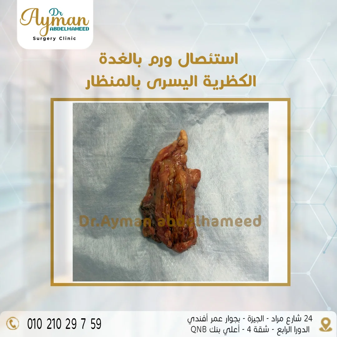 You are currently viewing استئصال ورم بالغدة الكظرية اليسرى بالمنظار