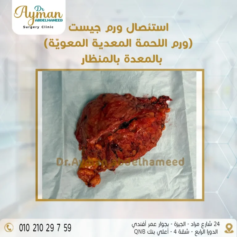 Read more about the article استئصال ورم اللحمة المعدية المعوية (GIST) بالمنظار