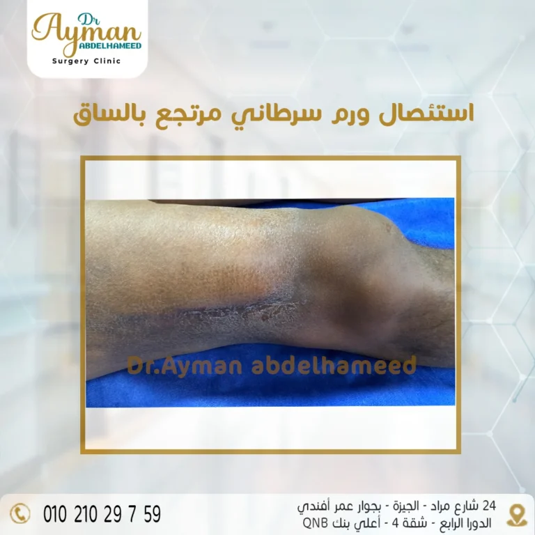 Read more about the article استئصال ورم سرطاني مرتجع بالساق