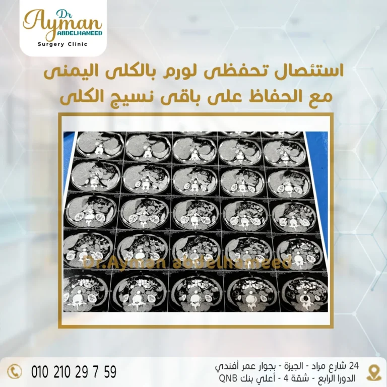 Read more about the article استئصال تحفظي ورم الكلى اليمنى مع الحفاظ على باقي نسيج الكلى