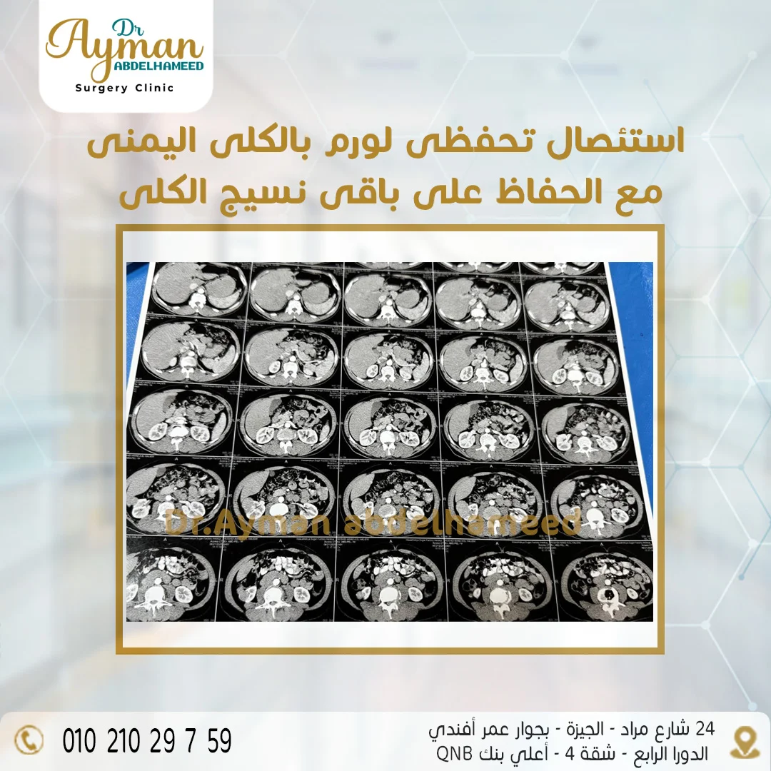 You are currently viewing استئصال تحفظي ورم الكلى اليمنى مع الحفاظ على باقي نسيج الكلى