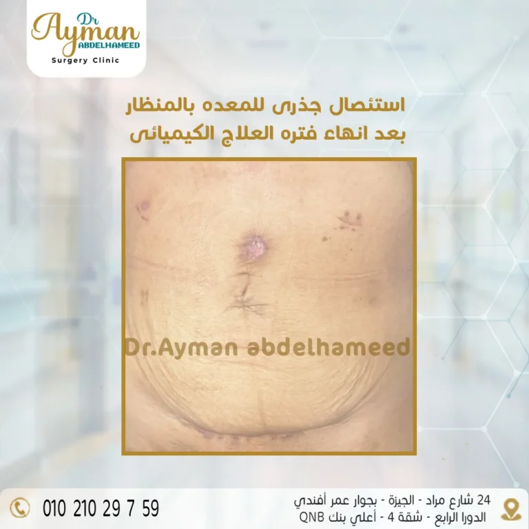 Read more about the article استئصال جذري للمعدة بالمنظار بعد العلاج الكيميائي