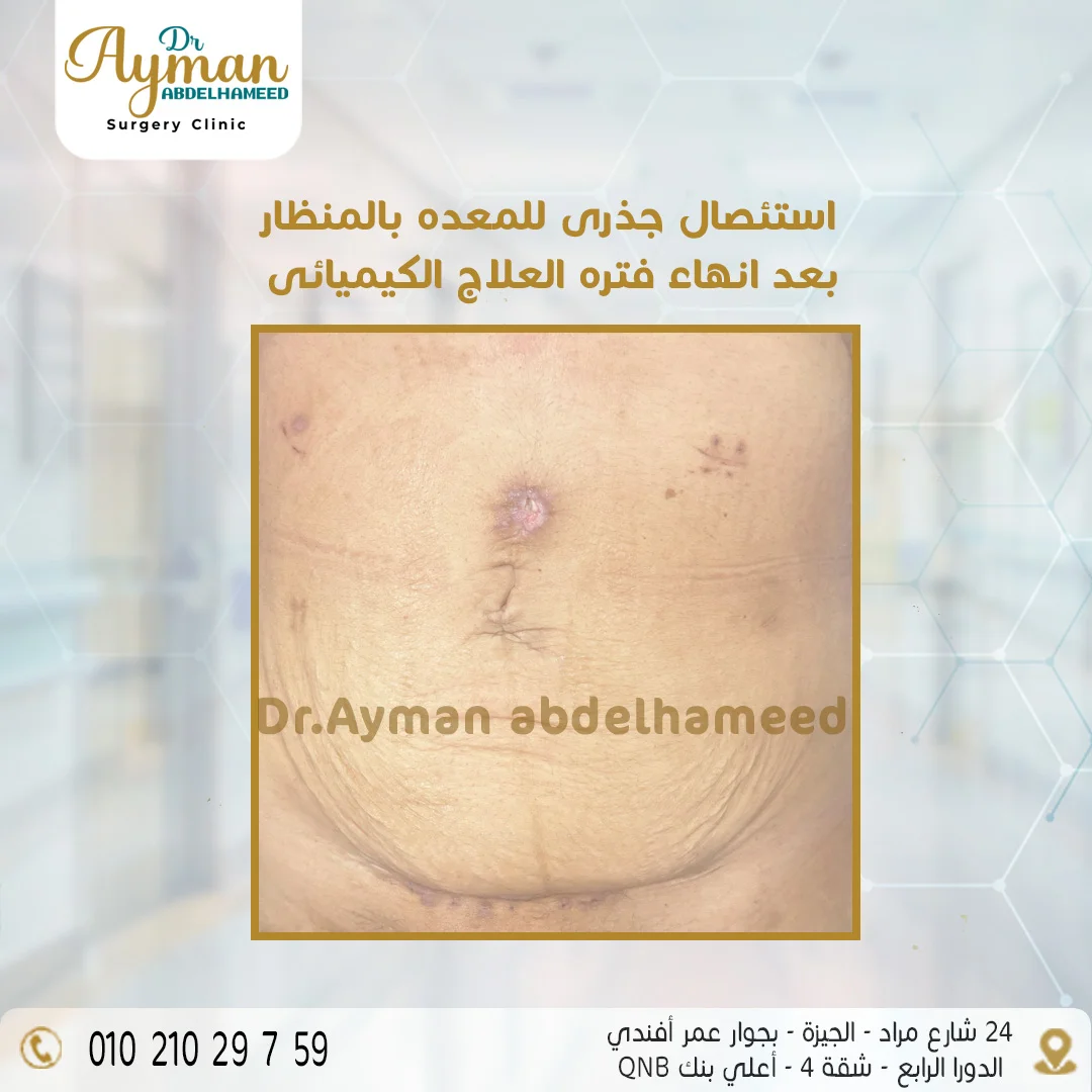 Read more about the article استئصال جذري للمعدة بالمنظار بعد العلاج الكيميائي