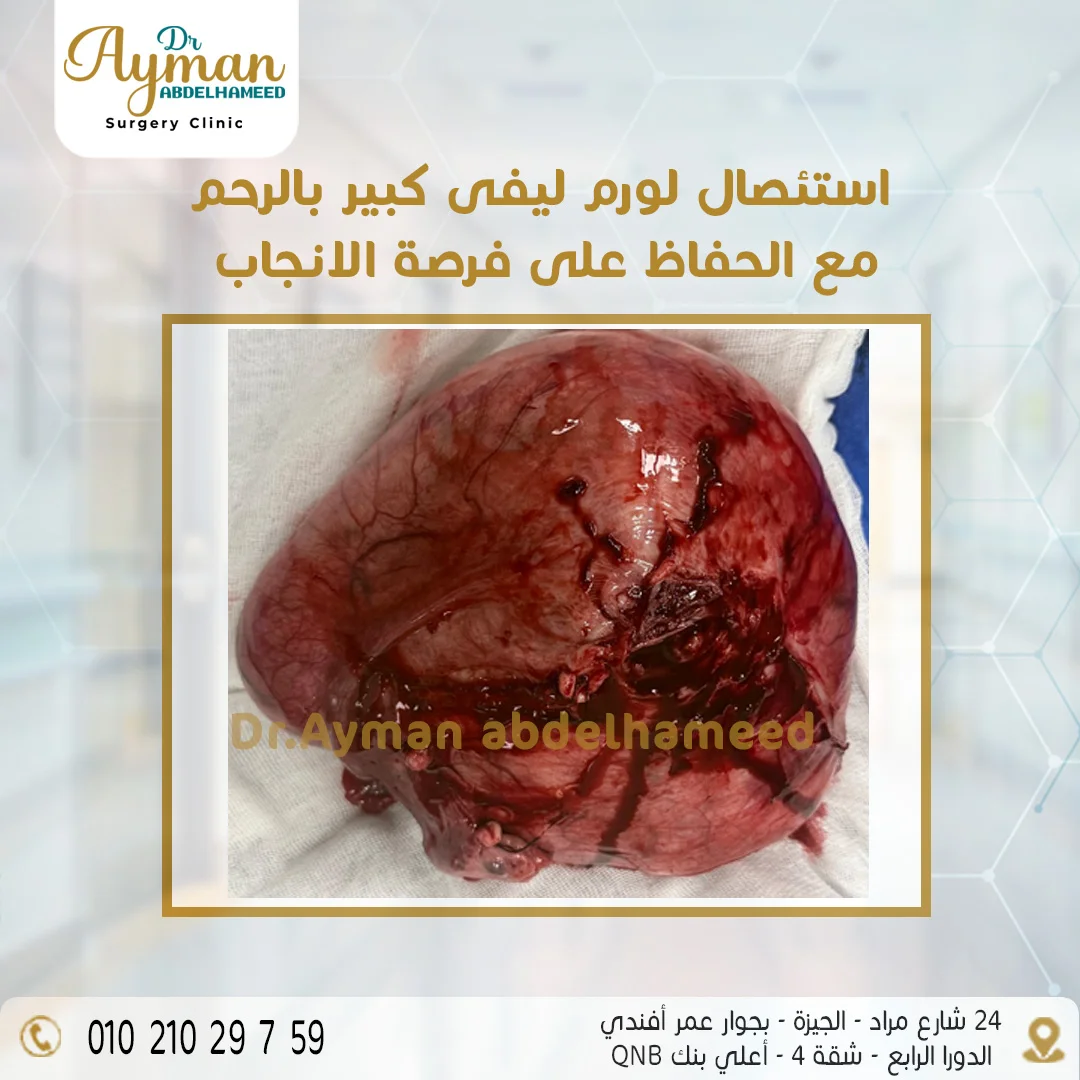 Read more about the article استئصال ورم ليفي كبير من الرحم مع الحفاظ على فرصة الإنجاب