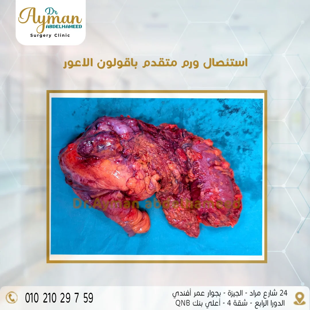 Read more about the article استئصال ورم متقدم بالقولون الاعور