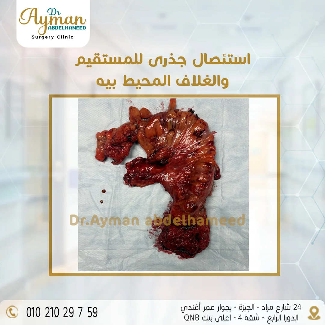 Read more about the article استئصال جذرى للمستقيم والغلاف المحيط بيه