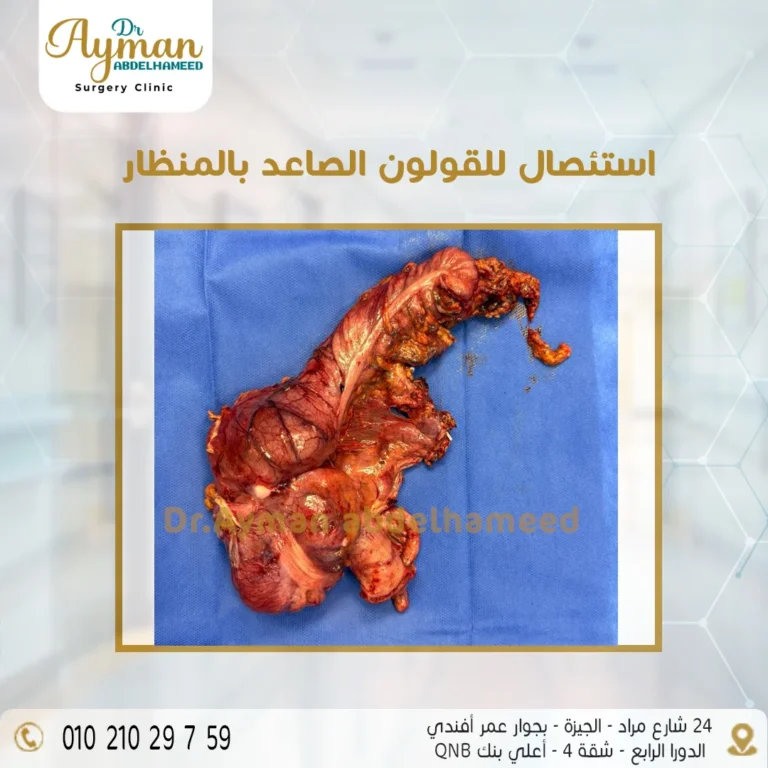 Read more about the article استئصال القولون الصاعد بالمنظار